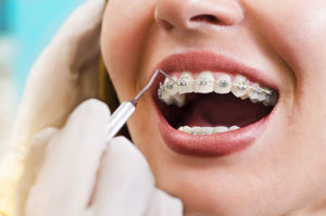 a doctor doing a routine cleaning around dental braces tx