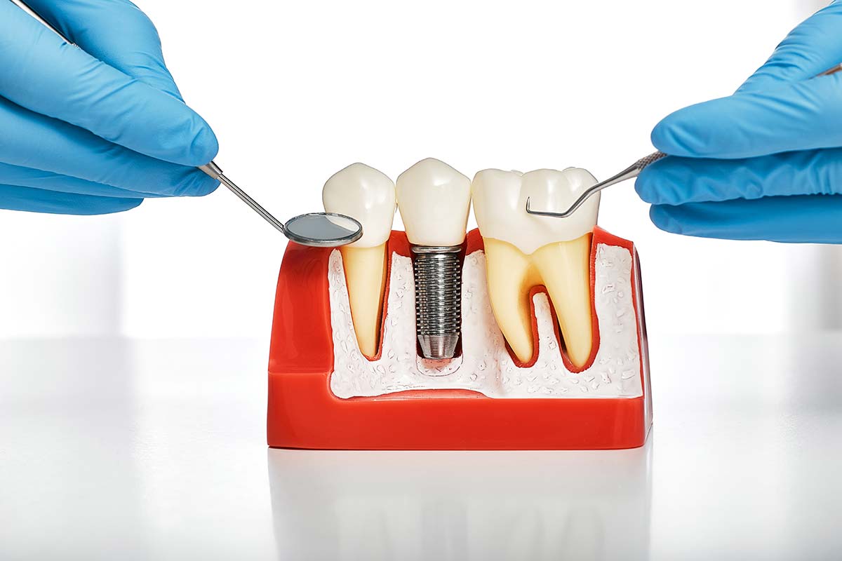 a model of dental implants