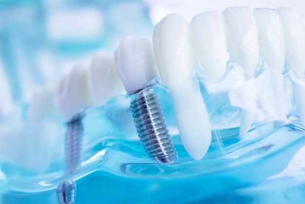 implant-dentist image of what implant dentist does