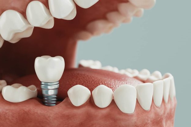 dental implants-2 (2) animation showing how dental implants work