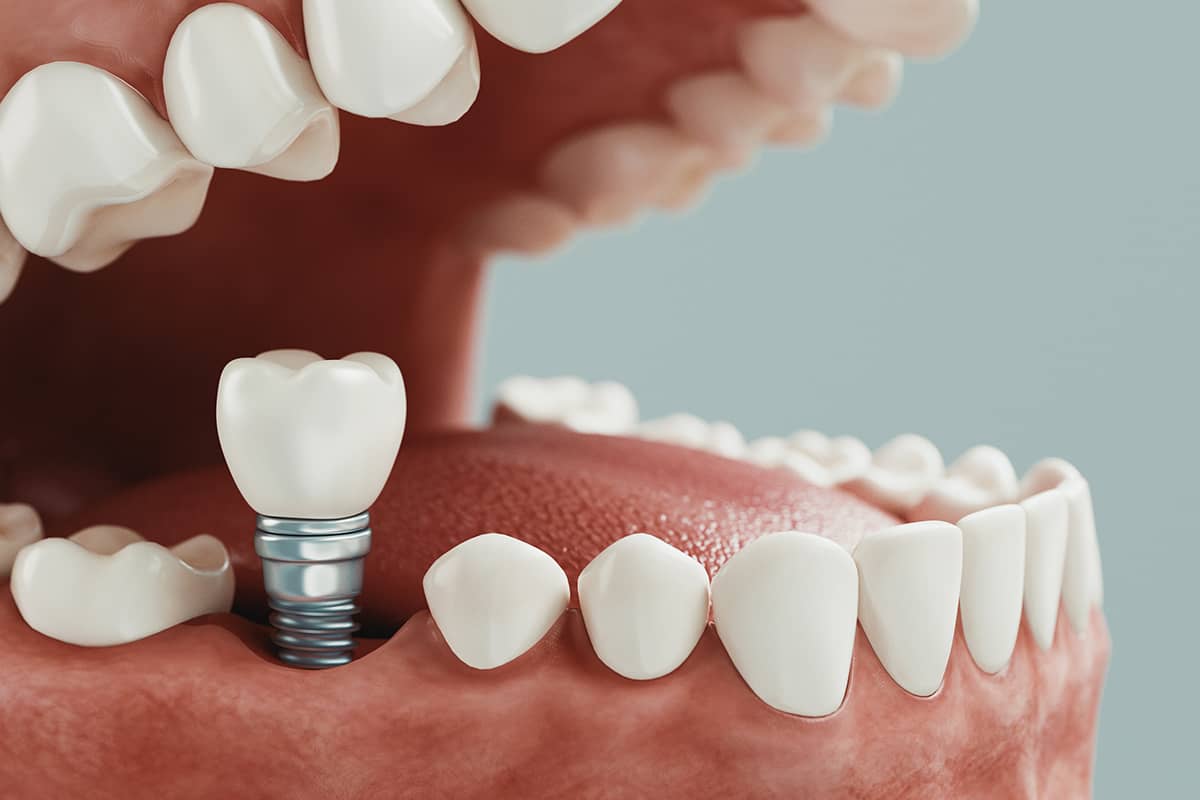 How Long Do Dental Implants Last Dental Implant Services TX