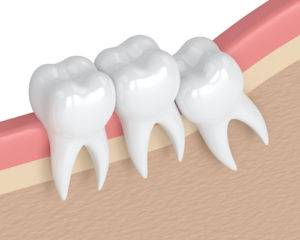 diagram shows what impacted teeth look like