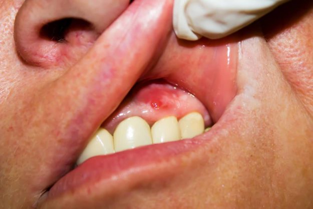 abscessed tooth example of an abscessed tooth