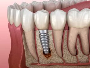 a model of dental implants is shown