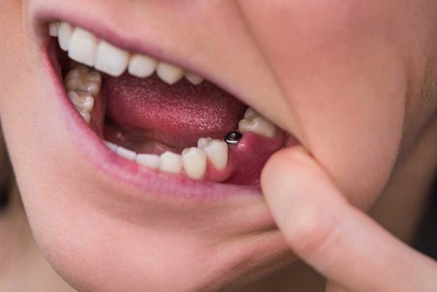 3-What-is-a-Single-Tooth-Implant- patient needing a single tooth implant