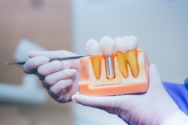 4 Benefits of Dental Implants (2) dentist showing example of dental implant