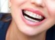 woman wearing dental braces