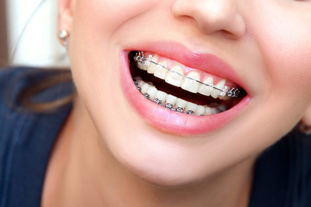 5 Signs You Need Dental Braces Again (2) woman wearing dental braces