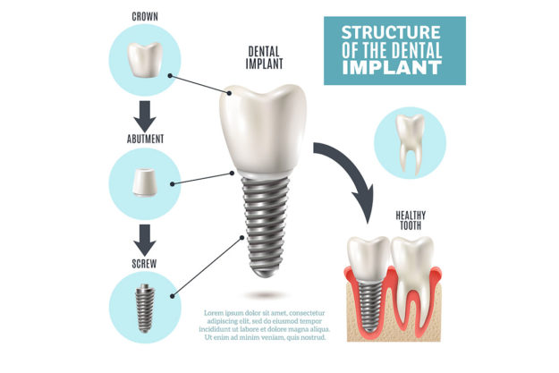 dental implants